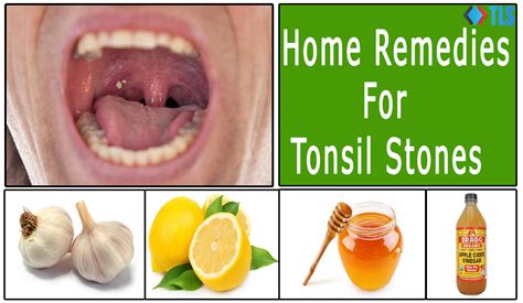 tonsil stones treatment